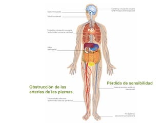 Obstrucción de las
arterias de las piernas
Pérdida de sensibilidad
 