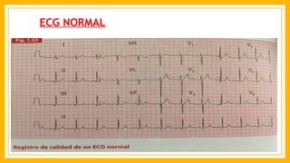 ECG NORMAL
 