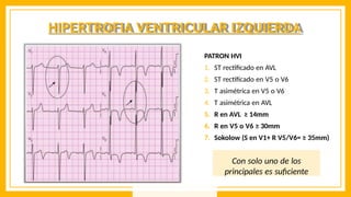 HIPERTROFIA VENTRICULAR IZQUIERDA
PATRON HVI
1. ST rectificado en AVL
2. ST rectificado en V5 o V6
3. T asimétrica en V5 o V6
4. T asimétrica en AVL
5. R en AVL ≥ 14mm
6. R en V5 o V6 ≥ 30mm
7. Sokolow (S en V1+ R V5/V6= ≥ 35mm)
Con solo uno de los
principales es suficiente
 