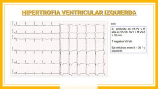 HIPERTROFIA VENTRICULAR IZQUIERDA
 