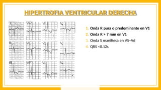 HIPERTROFIA VENTRICULAR DERECHA
1. Onda R pura o predominante en V1
2. Onda R > 7 mm en V1
3. Onda S manifiesa en V5−V6
4. QRS <0.12s
 