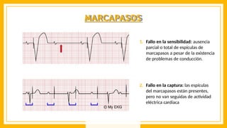 MARCAPASOS
1. Fallo en la sensibilidad: ausencia
parcial o total de espículas de
marcapasos a pesar de la existencia
de problemas de conducción.
2. Fallo en la captura: las espículas
del marcapasos están presentes,
pero no van seguidas de actividad
eléctrica cardíaca
 