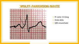 'WOLFF-PARKINSON-WHITE
1. Pr corto <0.12seg
2. Onda delta
3. QRS ensanchado
 
