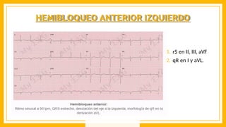 HEMIBLOQUEO ANTERIOR IZQUIERDO
1. rS en II, III, aVF
2. qR en I y aVL.
 