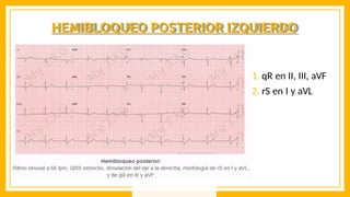 HEMIBLOQUEO POSTERIOR IZQUIERDO
1. qR en II, III, aVF
2. rS en I y aVL
 