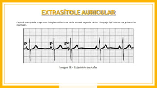 EXTRASÍTOLE AURICULAR
Onda P anticipada, cuya morfología es diferente de la sinusal seguida de un complejo QRS de forma y duración
normales.
 