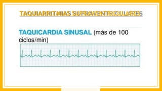 TAQUIARRITMIAS SUPRAVENTRICULARES
 