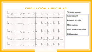 FIBRILACIÓN AURICULAR
 