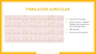 FIBRILACIÓN AURICULAR
● Intervalo R−R irregular
● Onda P ausente → Ondas f
(Pueden estar ausentes en
una FA de larga data)
● QRS estrecho
● Duración de 30 segundos
 