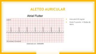 ALETEO AURICULAR
● Intervalo R−R regular
● Onda P ausente → Ondas de
sierra
 
