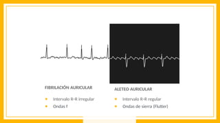 ALETEO AURICULAR
● Intervalo R−R regular
● Ondas de sierra (Flutter)
FIBRILACIÓN AURICULAR
● Intervalo R−R irregular
● Ondas f
 