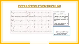 EXTRASÍSTOLE VENTRICULAR
QRS mayor a 0.12 seg
Latido adelantado
No precedido de onda P
 