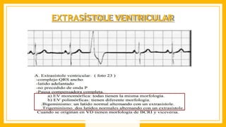 EXTRASÍSTOLE VENTRICULAR
 