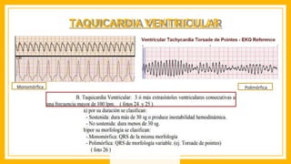 TAQUICARDIA VENTRICULAR
Monomórfica Polimórfica
 