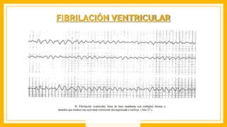 FIBRILACIÓN VENTRICULAR
 