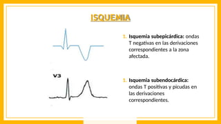 ISQUEMIA
1. Isquemia subepicárdica: ondas
T negativas en las derivaciones
correspondientes a la zona
afectada.
1. Isquemia subendocárdica:
ondas T positivas y picudas en
las derivaciones
correspondientes.
 