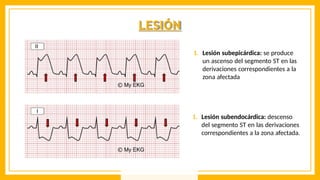 LESIÓN
1. Lesión subepicárdica: se produce
un ascenso del segmento ST en las
derivaciones correspondientes a la
zona afectada
1. Lesión subendocárdica: descenso
del segmento ST en las derivaciones
correspondientes a la zona afectada.
 