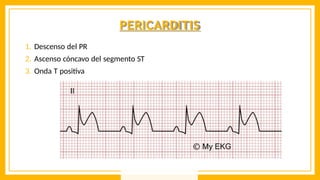 PERICARDITIS
1. Descenso del PR
2. Ascenso cóncavo del segmento ST
3. Onda T positiva
 