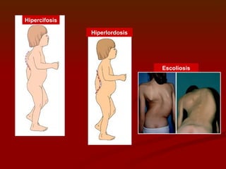 Hipercifosis Hiperlordosis Escoliosis 
