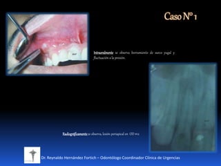 CasoN°1
Dr. Reynaldo Hernández Fortich – Odontólogo Coordinador Clínica de Urgencias
Intraoralmente se observa borramiento de surco yugal y
fluctuación a la presión.
Radiográficamentese observa, lesión periapical en OD #12
 