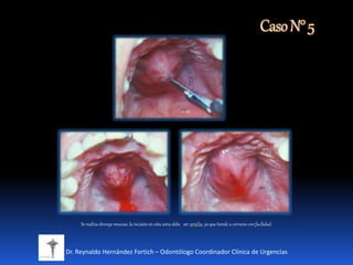 CasoN°5
Dr. Reynaldo Hernández Fortich – Odontólogo Coordinador Clínica de Urgencias
Se realiza drenaje mucoso, la incisiónen esta zona debe ser amplia, ya que tiende a cerrarse con facilidad.
 