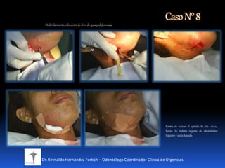CasoN°8
Dr. Reynaldo Hernández Fortich – Odontólogo Coordinador Clínica de Urgencias
Desbridamiento, colocaciónde dren de gasa yodoformada
Forma de colocar el apósito. Se cita en 24
horas. Se ordeno ingesta de abundantes
líquidos y dieta liquida.
 