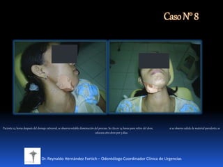 CasoN°8
Dr. Reynaldo Hernández Fortich – Odontólogo Coordinador Clínica de Urgencias
Paciente 24 horas después del drenaje extraoral, se observa notable disminución del proceso. Se cita en 24 horas para retiro del dren, si se observa salida de material purulento, se
colocara otrodren por 3 días.
 