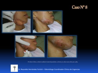 CasoN°8
Dr. Reynaldo Hernández Fortich – Odontólogo Coordinador Clínica de Urgencias
Al retirar el dren, se observo salida de material purulento, se drenó y se coloco nuevo dren por 3 días.
 