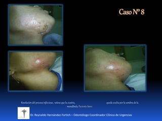 CasoN°8
Dr. Reynaldo Hernández Fortich – Odontólogo Coordinador Clínica de Urgencias
Resolución del proceso infeccioso, nótese que la cicatriz, queda oculta por la sombra de la
mandíbula, Paciente Sano.
 