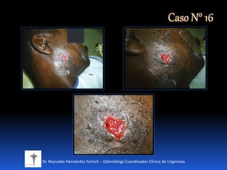 Dr. Reynaldo Hernández Fortich – Odontólogo Coordinador Clínica de Urgencias
Caso N° 16
 