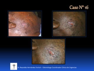 Dr. Reynaldo Hernández Fortich – Odontólogo Coordinador Clínica de Urgencias
Caso N° 16
 