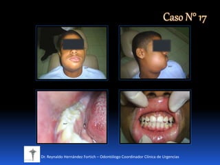 Dr. Reynaldo Hernández Fortich – Odontólogo Coordinador Clínica de Urgencias
Caso N° 17
 