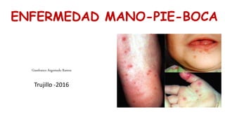 ENFERMEDAD MANO-PIE-BOCA
Gianfranco Argomedo Ramos
Trujillo -2016
 