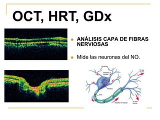 OCT, HRT, GDx
          ANÁLISIS CAPA DE FIBRAS
           NERVIOSAS

          Mide las neuronas del NO.
 