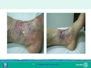 Día 0

        Día 20

                        2 meses



         2 meses de evolución
 