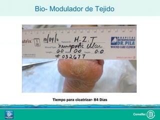 Bio- Modulador de Tejido




     Tiempo para cicatrizar- 84 Días
 