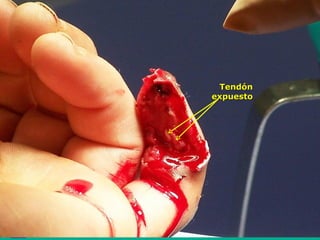 Tendón
expuesto
 