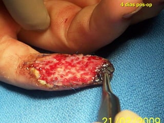 4 días pos-op
 