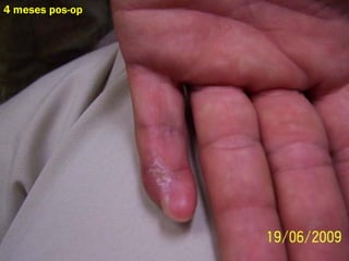 4 meses pos-op
 