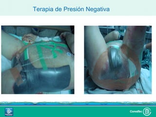 Terapia de Presión Negativa
 