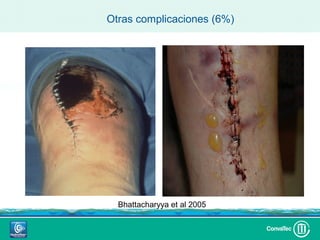 Otras complicaciones (6%)




  Bhattacharyya et al 2005
 