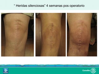 “ Heridas silenciosas” 4 semanas pos operatorio
 