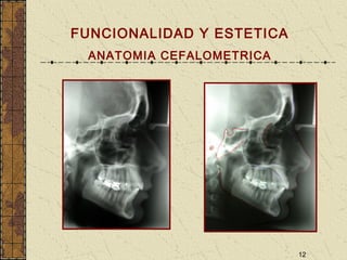 12
FUNCIONALIDAD Y ESTETICA
ANATOMIA CEFALOMETRICA
 