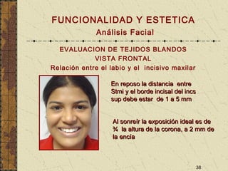 38
FUNCIONALIDAD Y ESTETICA
Análisis Facial
EVALUACION DE TEJIDOS BLANDOS
VISTA FRONTAL
Relación entre el labio y el incisivo maxilar
En reposo la distancia entreEn reposo la distancia entre
Stmi y el borde incisal del incsStmi y el borde incisal del incs
sup debe estar de 1 a 5 mmsup debe estar de 1 a 5 mm
Al sonreír la exposición ideal es deAl sonreír la exposición ideal es de
¾ la altura de la corona, a 2 mm de¾ la altura de la corona, a 2 mm de
la encíala encía
 