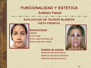 41
FUNCIONALIDAD Y ESTETICA
Análisis Facial
EVALUACION DE TEJIDOS BLANDOS
VISTA FRONTAL
Simetría facial
Glabela
Punta nasal
Punto medio del labio sup
Punto medio del mentón
Analisis de quintos
Distancia intercanal interna
Distancia intercanal inermedia
Distancia intercanal externa
 