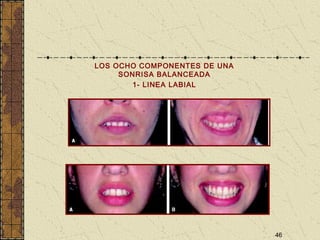 46
LOS OCHO COMPONENTES DE UNA
SONRISA BALANCEADA
1- LINEA LABIAL
 