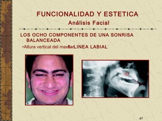 47
FUNCIONALIDAD Y ESTETICA
Análisis Facial
LOS OCHO COMPONENTES DE UNA SONRISA
BALANCEADA
1- LINEA LABIAL•Altura vertical del maxilar
 