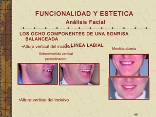 49
FUNCIONALIDAD Y ESTETICA
Análisis Facial
LOS OCHO COMPONENTES DE UNA SONRISA
BALANCEADA
1- LINEA LABIAL•Altura vertical del incisivo:
Sobremordida vertical
proinclinacion
Mordida abierta
•Altura vertical del incisivo
 