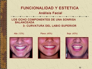 52
FUNCIONALIDAD Y ESTETICA
Análisis Facial
LOS OCHO COMPONENTES DE UNA SONRISA
BALANCEADA
3- CURVATURA DEL LABIO SUPERIOR
Alta (12%) Plana (45%) Baja (43%)
 