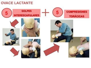 OVACE LACTANTE
5 5GOLPES
INTERESCAPULARES
COMPRESIONES
TORÁCICAS
 